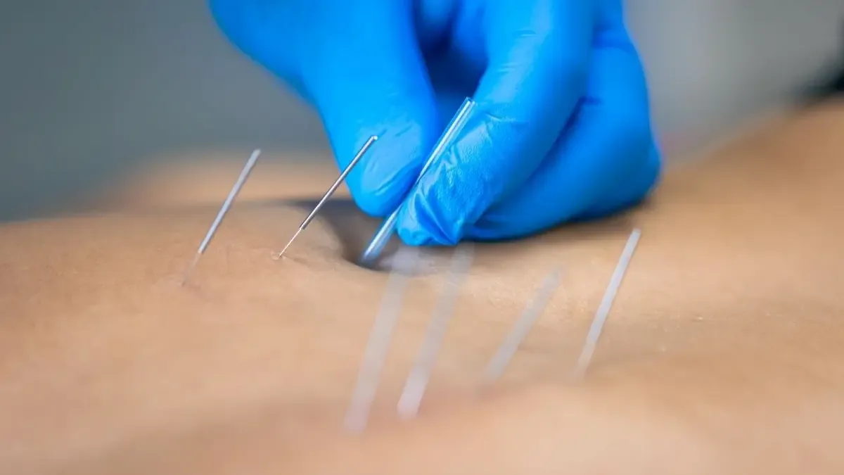 Acupuntura