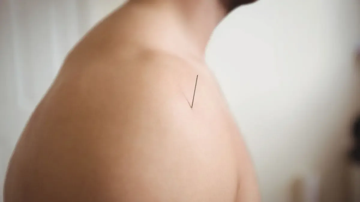 Acupuntura cura tendinite