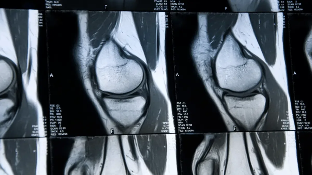 Edema ósseo tem cura?